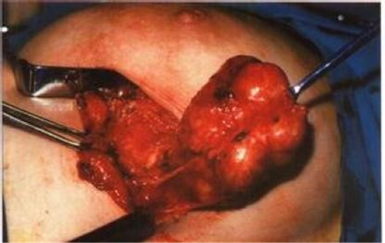 乳腺纤维瘤真人图片图片