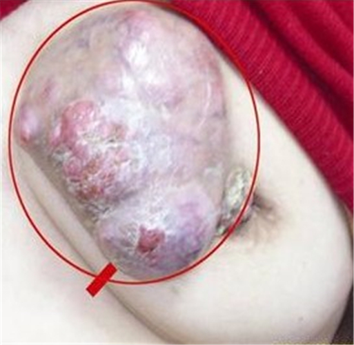 乳腺癌的晚期症状图片图片