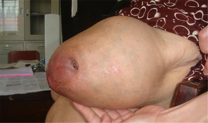 乳腺纤维瘤乳房的图片