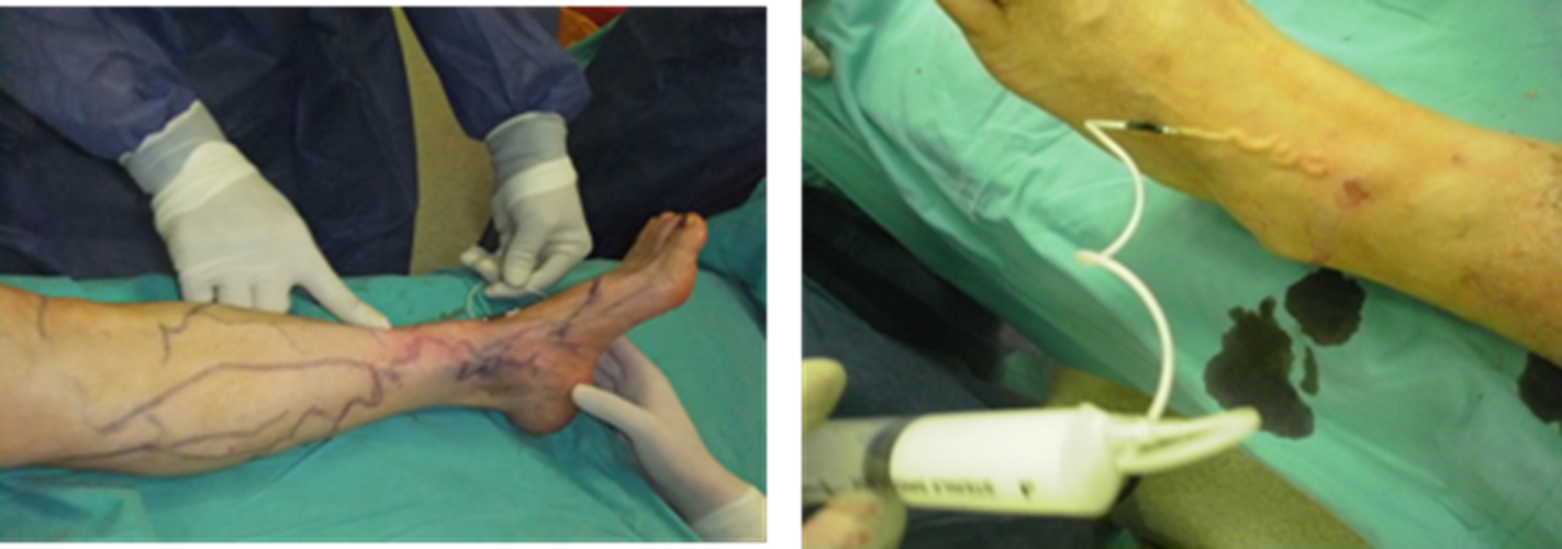腿下肢静脉曲张手术分解图片