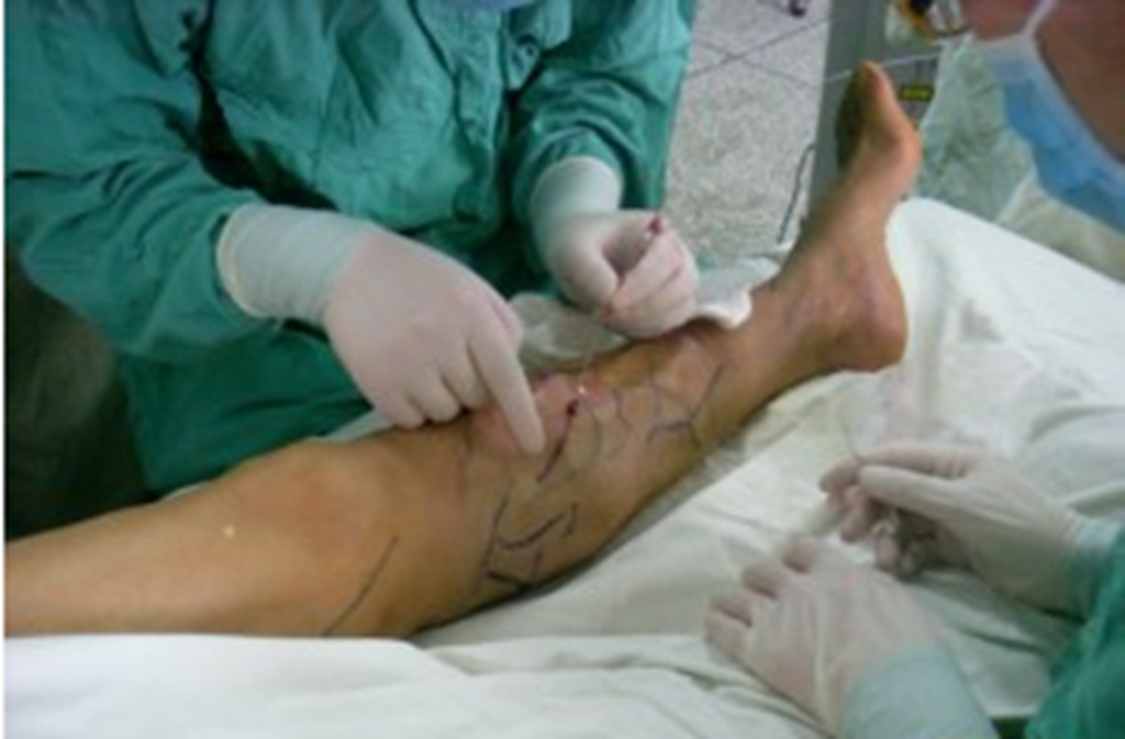 下肢静脉曲张患者手术治疗图片