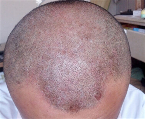 男性头部毛囊炎图片图片