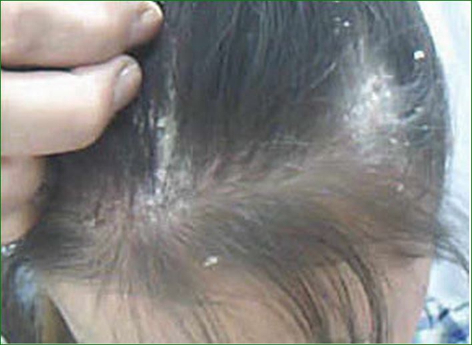 头皮真菌感染的症状图片