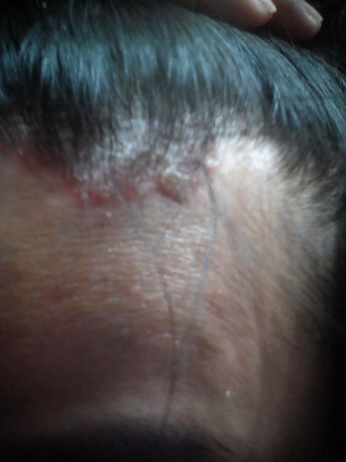 头皮湿疹的症状图片图片
