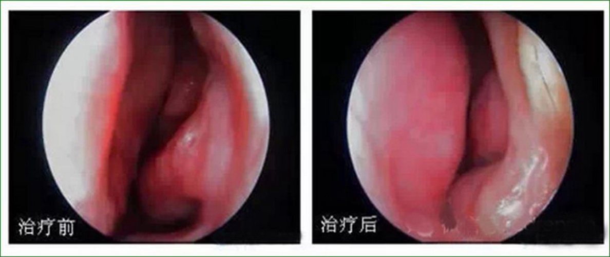 声带息肉的临床症状图片