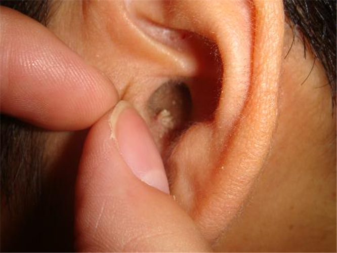 外耳道肉芽肿图片图片