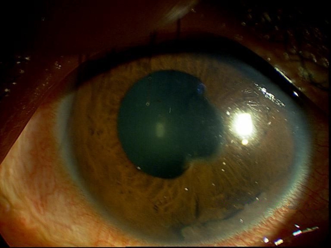 葡萄膜炎虹膜青光眼图片