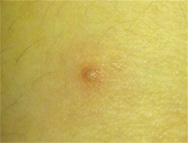 毛囊炎起的小痘痘图片图片