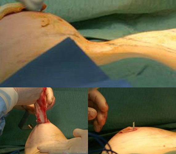 隆胸手术过程 实拍图片
