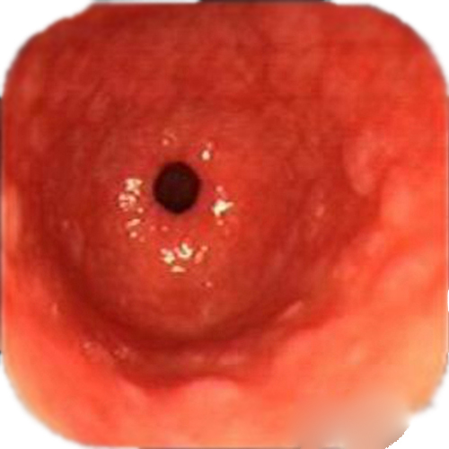 慢性浅表性胃炎胃镜图片