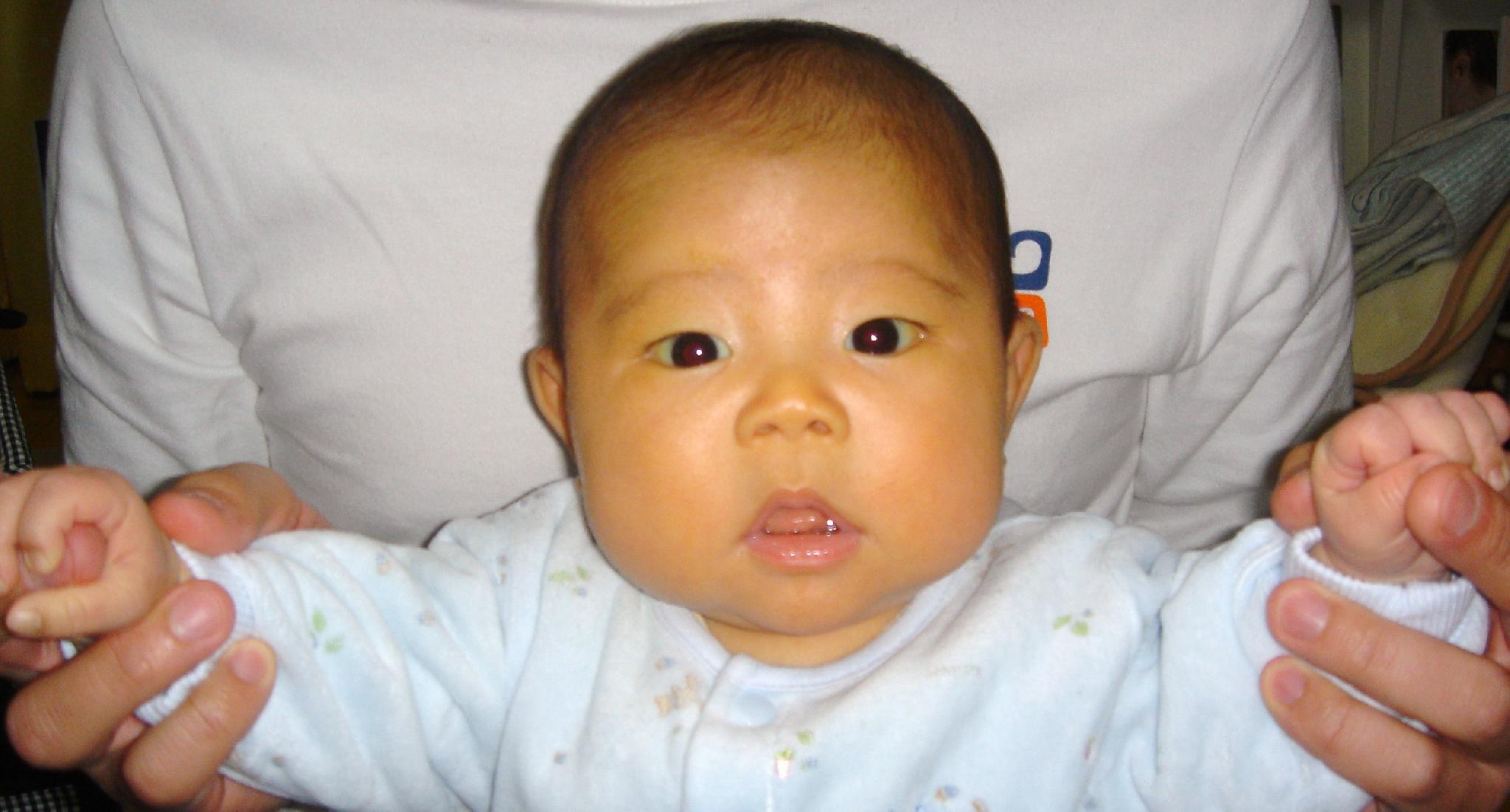 宝宝母乳性黄疸眼白黄图片