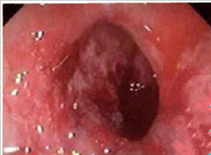 老人慢性肠炎的直肠镜图片