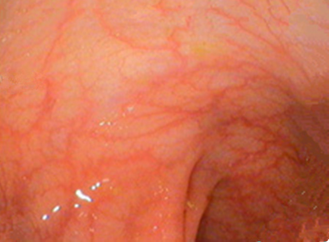 慢性肠炎的镜下图片