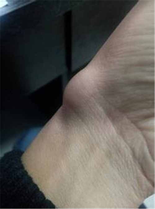 大拇指腱鞘炎症状图图片