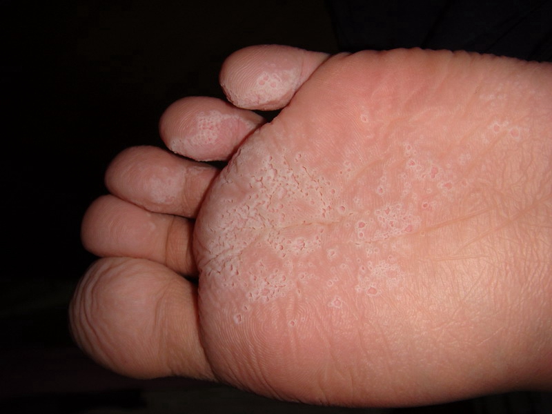 脚藓症状有什么表现的图片