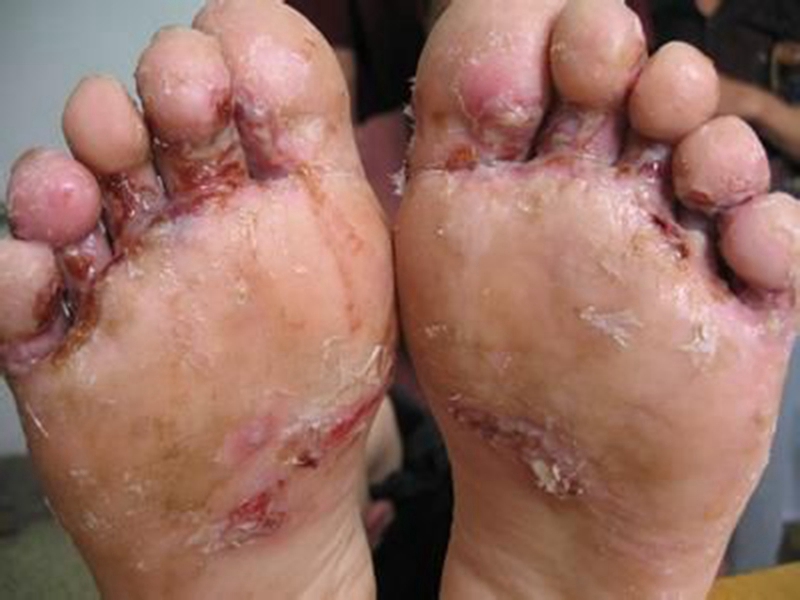 真菌脚气症状图片图片