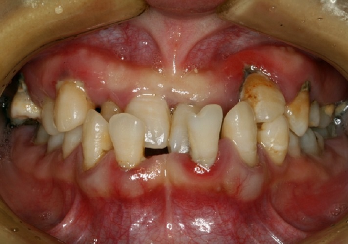 极度慢性牙周炎图片
