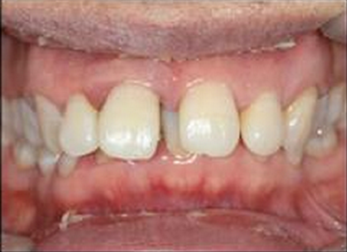 慢性牙周炎常见的图片