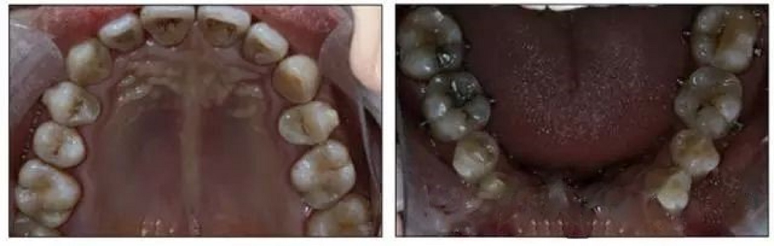 慢性牙周炎导致前牙漂移图片