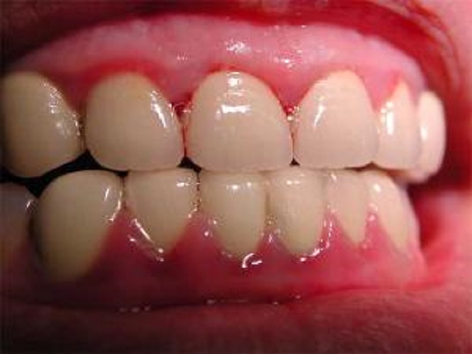 轻微慢性牙周炎图片