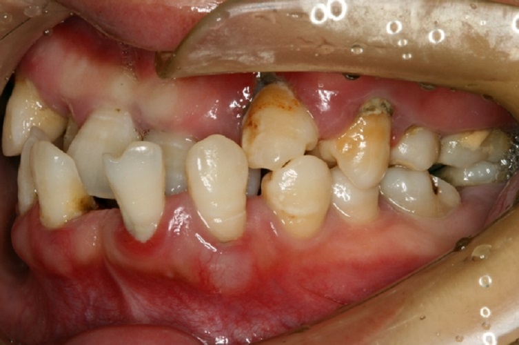 严重影响生活的慢性牙周炎图片