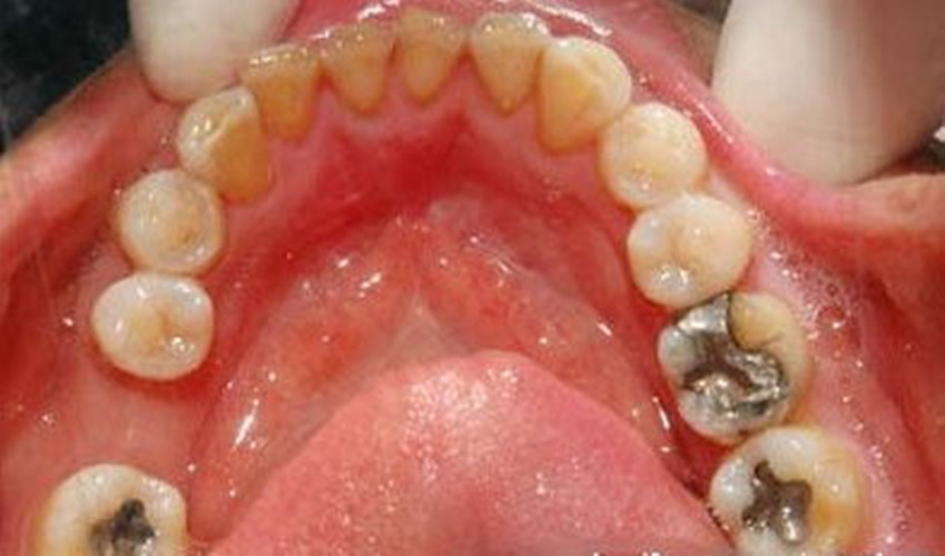 病人慢性牙髓炎口腔图片