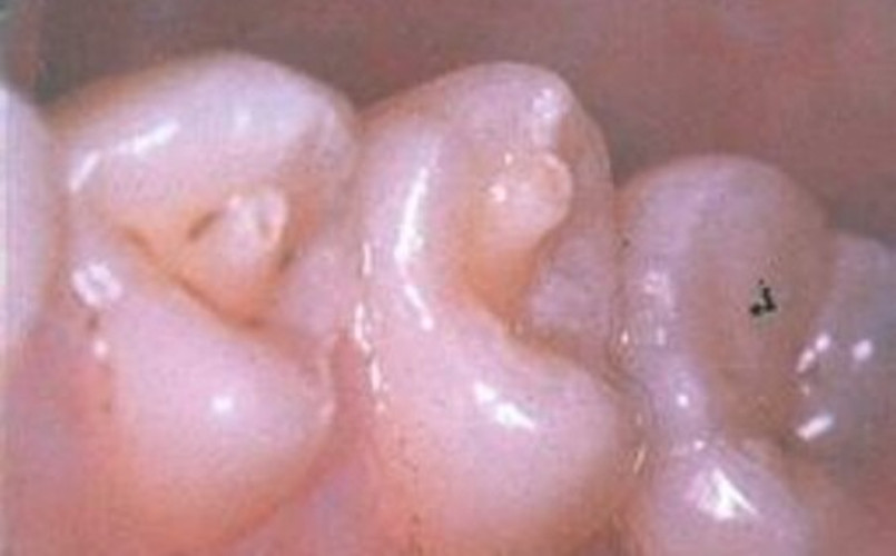 初期慢性牙髓炎图片