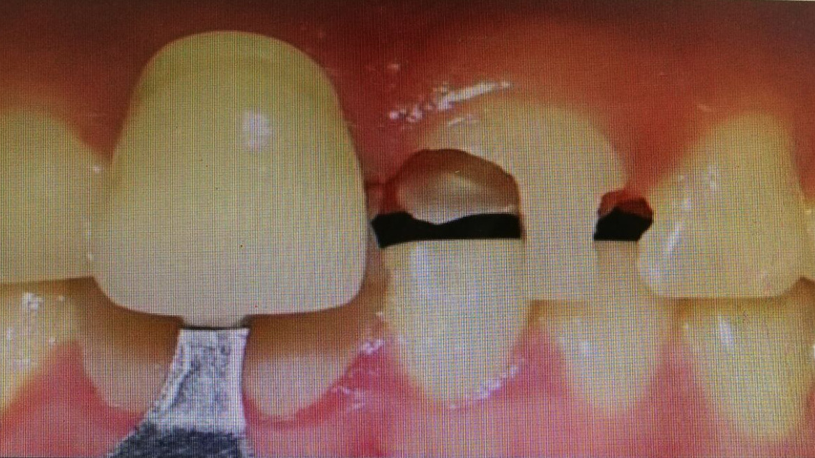 口腔慢性牙髓炎的图片