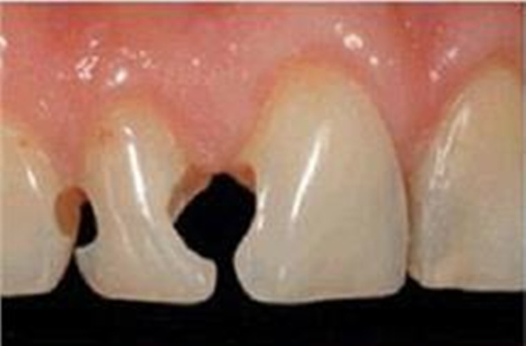 慢性牙髓炎中期图片