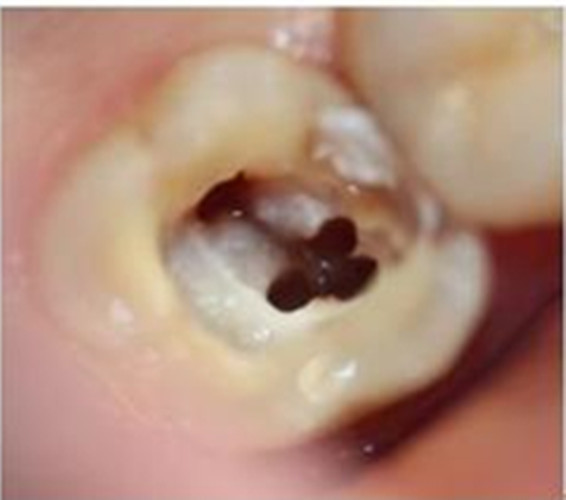 慢性牙髓炎可复性的图片 