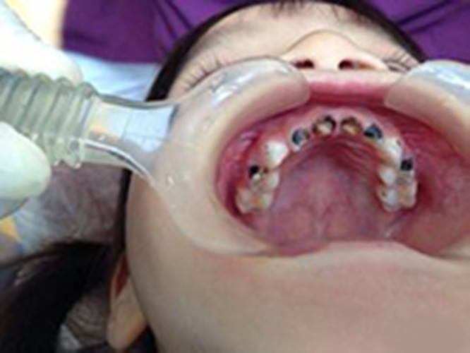 慢性牙髓炎儿童图片