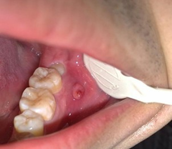 慢性牙髓炎口腔之图片