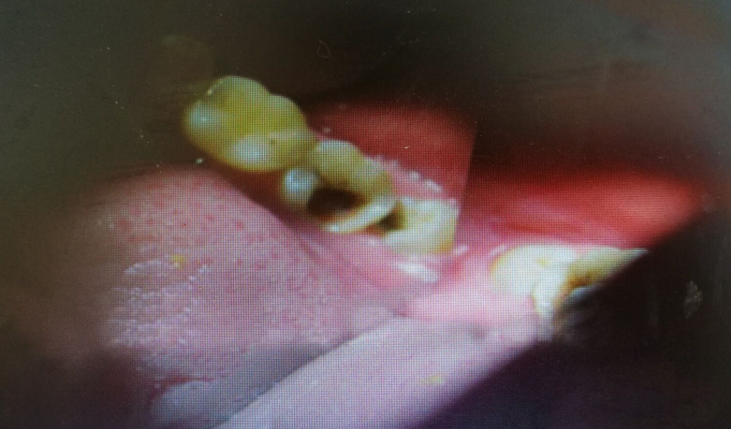 慢性牙髓炎清晰图片