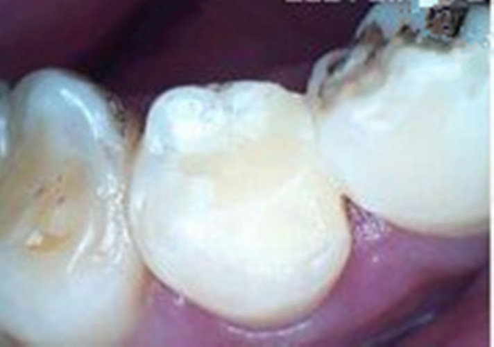 慢性牙髓炎轻的图片
