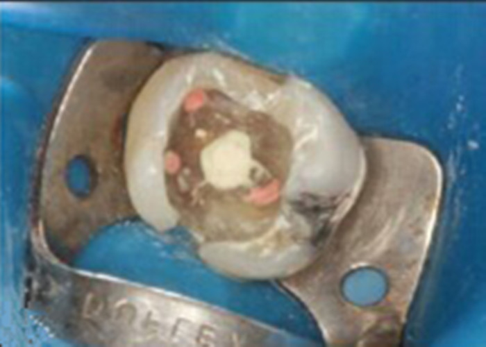 慢性牙髓炎图单图片