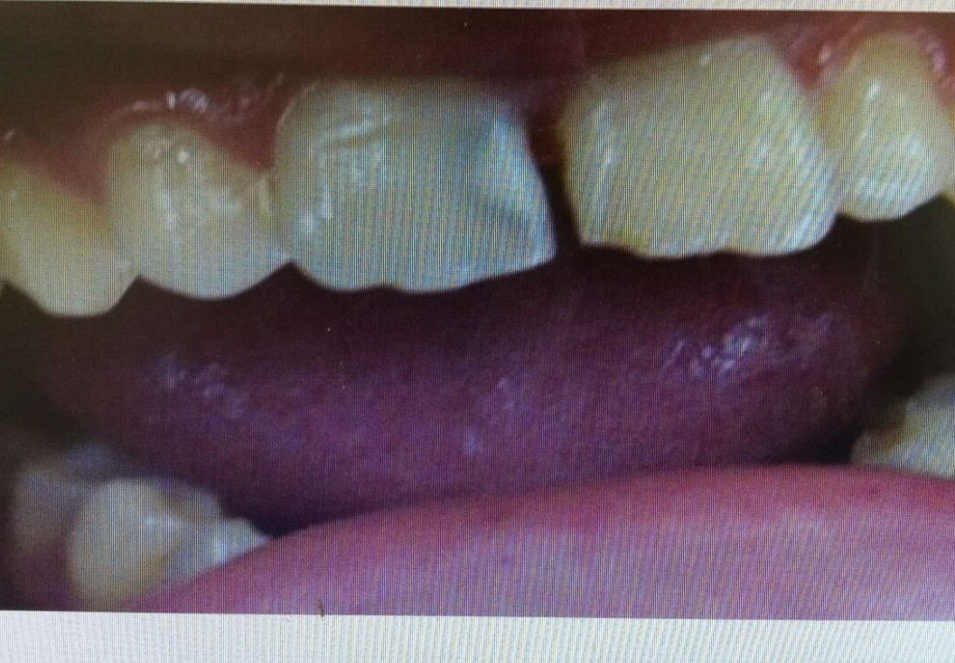 慢性牙髓炎早期图片