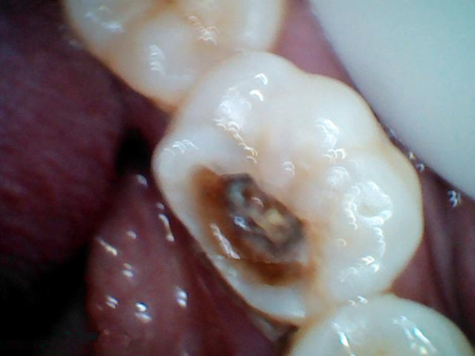 慢性牙髓炎治疗后图片