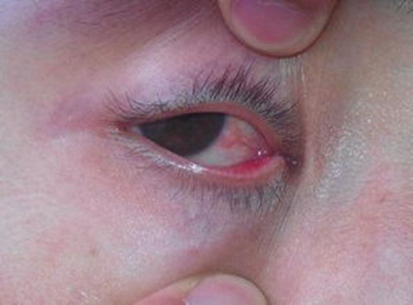疱疹眼睛角膜炎图片图片