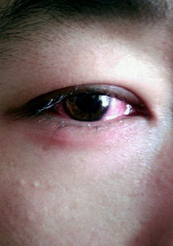 一般性角膜炎初期图片