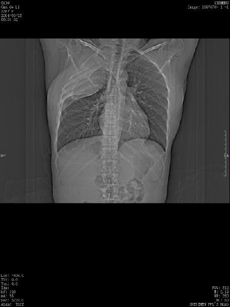 微波消融联合粒子植入治疗右胸部巨大纤维瘤