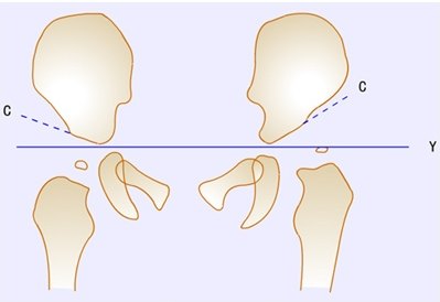 1939年wiberg首先采用测量ce角的方法评价股骨头与髋臼的关系,认为ce