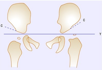 髋臼ce角正常值图片