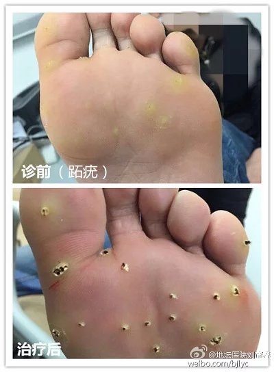 鸡眼和脚垫的区别