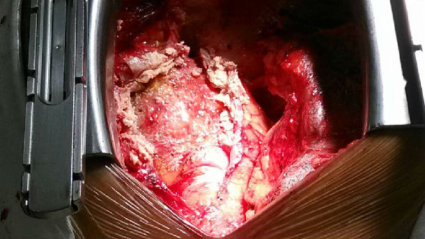 缩窄性心包炎合并心包干酪样坏死-有来医生