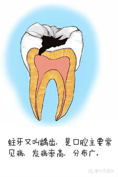 蛀牙是如何炼成的?