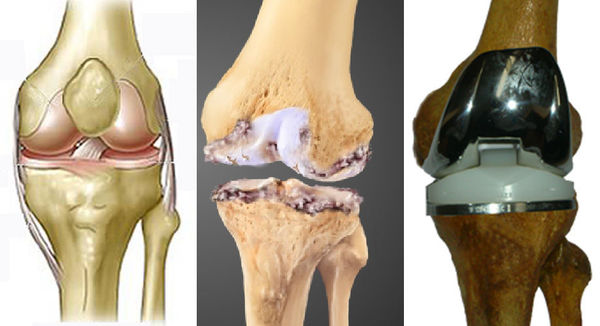 有关膝关节置换术的常见问题及解答