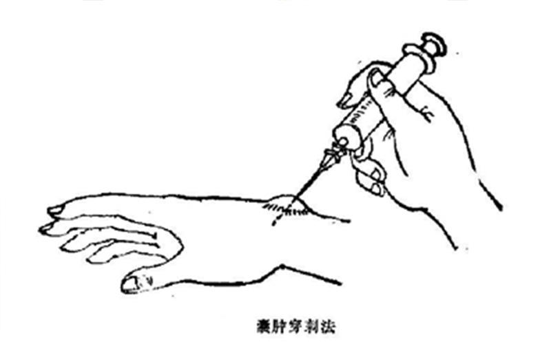 拇囊炎按摩手法图片