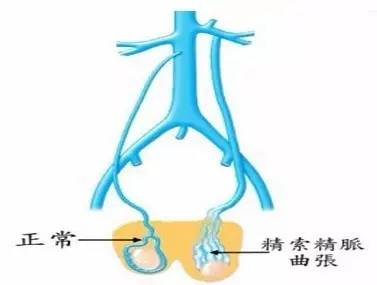 男人静脉曲张怎么治