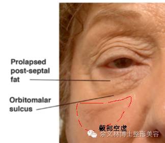 眼部老化的十大表现