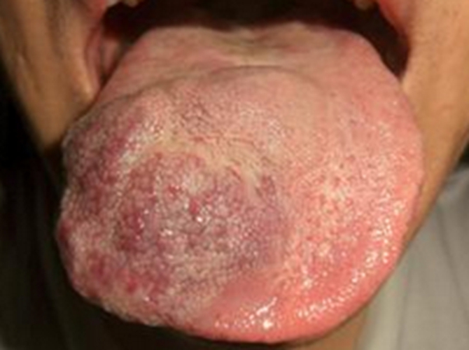 舌头边血管瘤图片大全图片